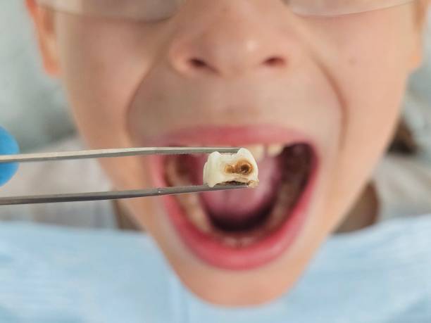 Best Emergency Treatment for Toothache in Electra, TX