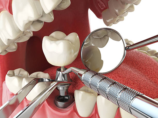 Best Emergency Root Canal Treatment in Electra, TX